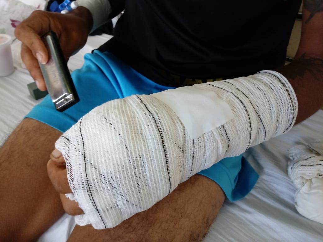 Malabarista tem mão golpeada por terçado durante assalto em Macapá (ajudem a campanha em prol dos artistas de rua)